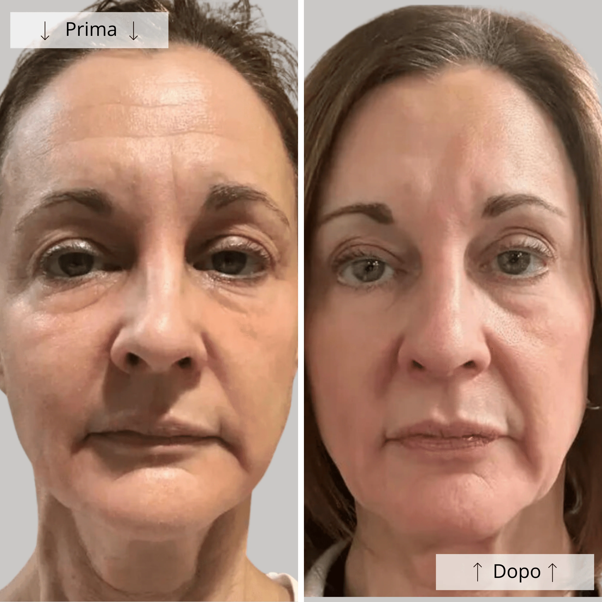 Lyra™ Maschera Led Anti Età